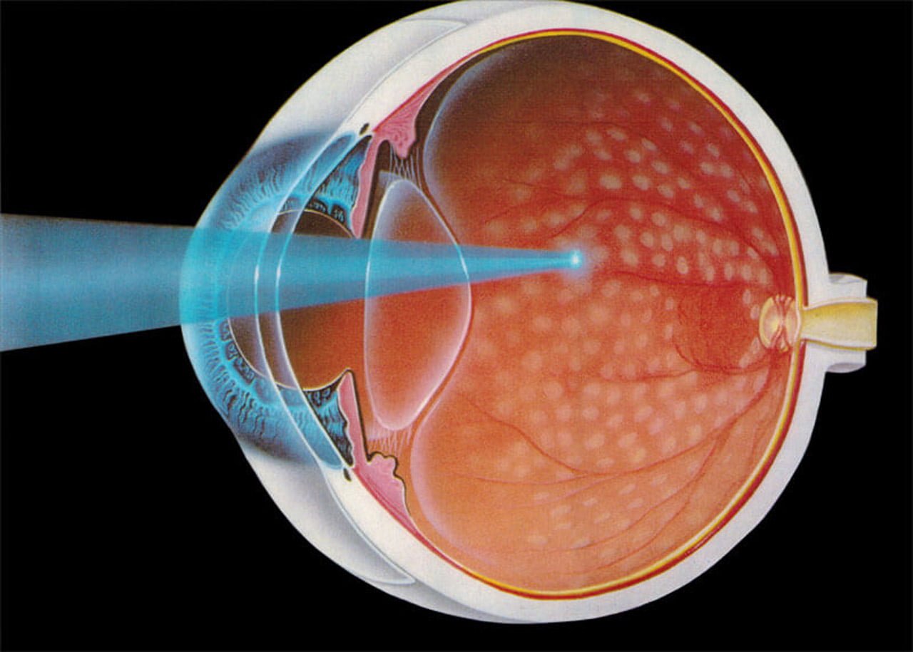 Клиника глаза сетчатки. Лазерная коагуляция сетчатки. Фокальная лазеркоагуляция сетчатки. Периферическая лазеркоагуляция сетчатки глаза. Отграничительная лазеркоагуляция сетчатки глаз.